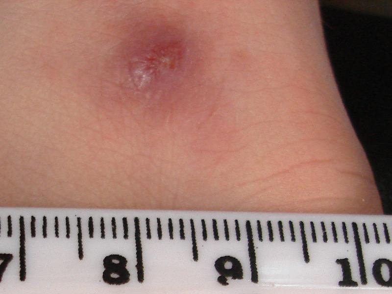 Photograph of a skin lesion created by cutaneous leishmaniasis, with a scale to represent estimate size of the lesion.
