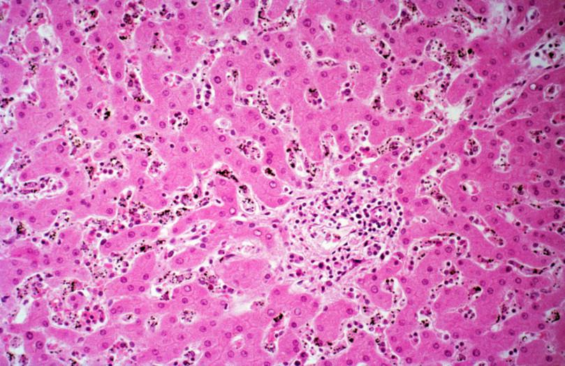 Micrograph of liver tissue. Most of the tissue is stained pink, but the hemozoin pigments are dark purple and dispersed throughout the tissue.

