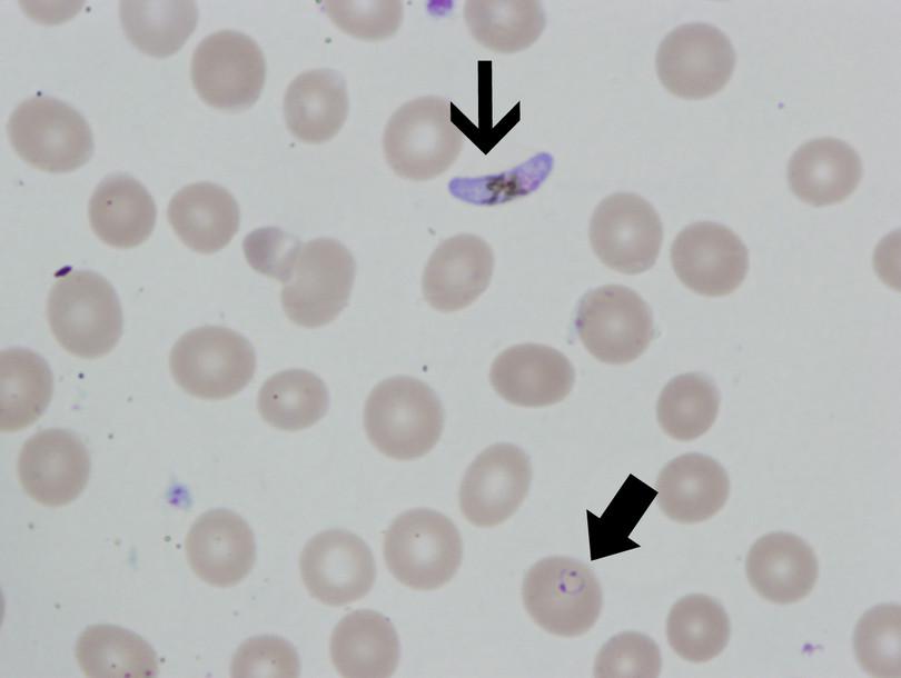 Micrograph of a blood smear with an arrow pointing to an oblong gametocyte of P. falciparum as well as another arrow pointing to an infected red blood cell with the ring form of the parasite.
